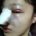 北京扇形重睑+膨体隆鼻+耳软骨垫鼻尖_图0