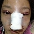 北京扇形重睑+膨体隆鼻+耳软骨垫鼻尖_图2