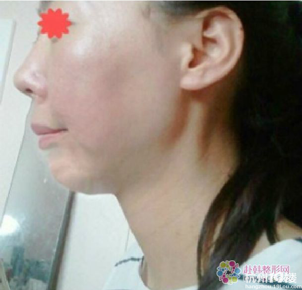 突嘴和鼻部整形手术后记