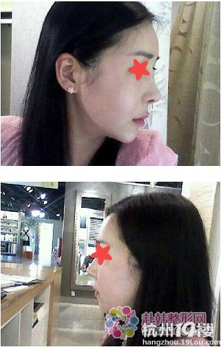 突嘴和鼻部整形手术后记