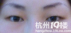 切开双眼皮整形日记