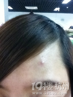 【试用】之妙芙乐控油祛痘洁肤笔+祛痘高手