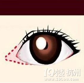 什么是开眼角手术 开眼角整形手术的十大保障