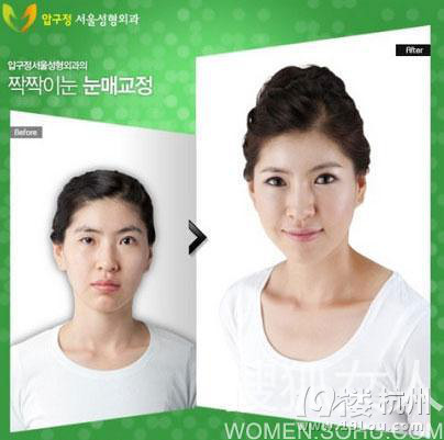 31个惊人的韩国整容术案例