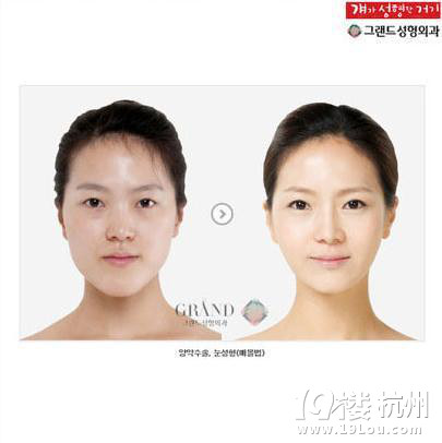 31个惊人的韩国整容术案例