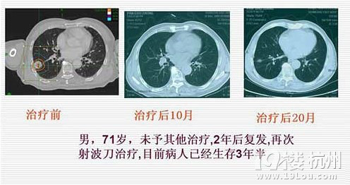 射波刀治疗肺癌病例五