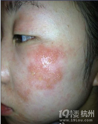 在线咨询--痘痘、激素性皮炎、激素痘-第260页-问题肌肤-美容护肤-杭州19楼