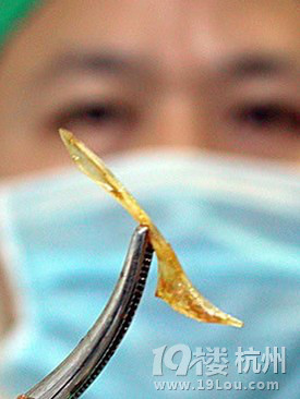 女子被2厘米鱼刺卡喉 吞饭团扎破食道化脓丧命