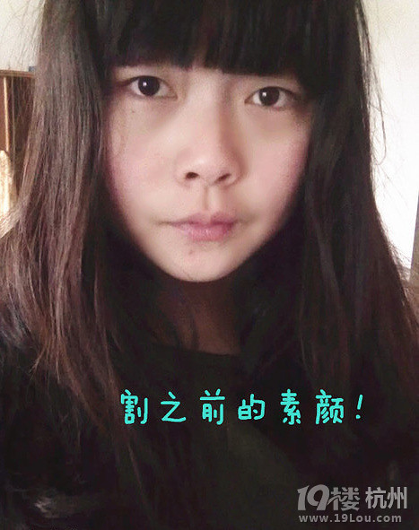 开双眼皮。三点定位+抽脂，更新到2个月效果