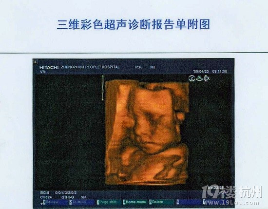 三维彩超什么时候做-准妈妈俱乐部-准妈妈论坛