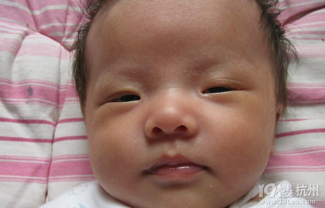 黄疸的治疗方法