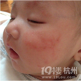 OMG 狗狗也能诱发儿童特应性皮炎