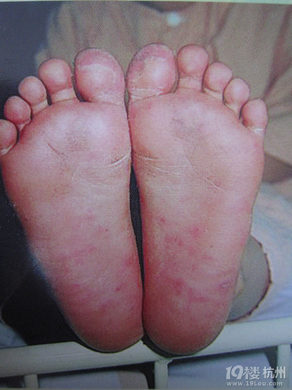 手足口病是什么症状?-健康资讯-健康之家-杭州