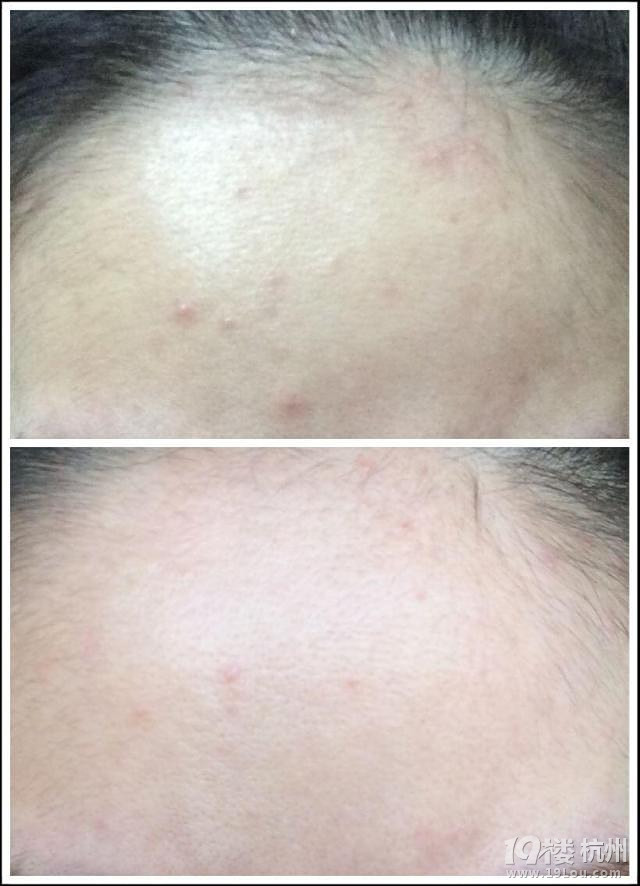 去痘印中药面膜★■什么中药面膜好用