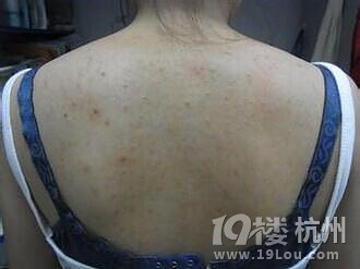 为什么背后会长痘痘？去除背后痘痘的小妙招！