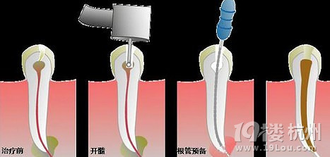 牙髓炎怎么办 牙疼不是病,疼起来要人命
