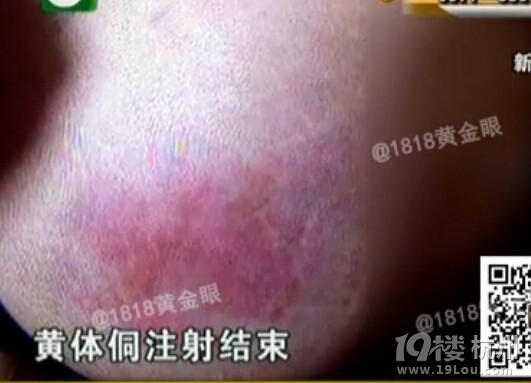 使用天津双燕牌子黄体酮的孕妈妈们注意了！！