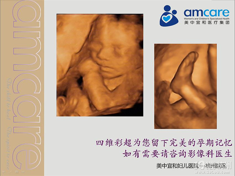 杭州四维彩超检查 全方位排畸检查宝宝