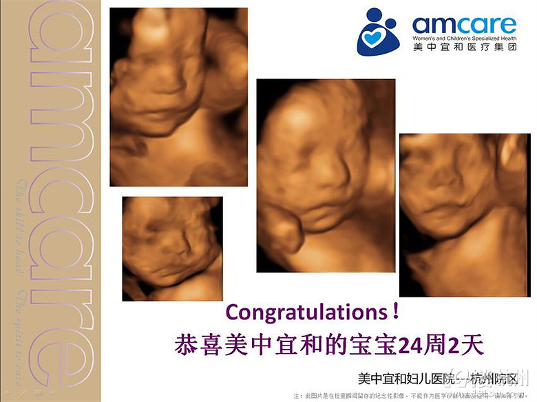 杭州四维彩超检查 全方位排畸检查宝宝