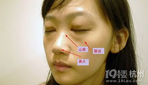 杭州隆鼻+祛眼袋对比图-鼻部-整容日记-杭州1