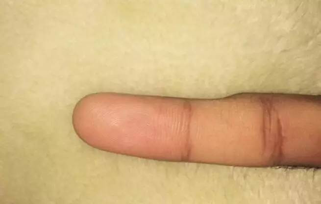 力，手指麻木握不住东西，大拇指活动时肌腱会痛等。而且，复发率很高。