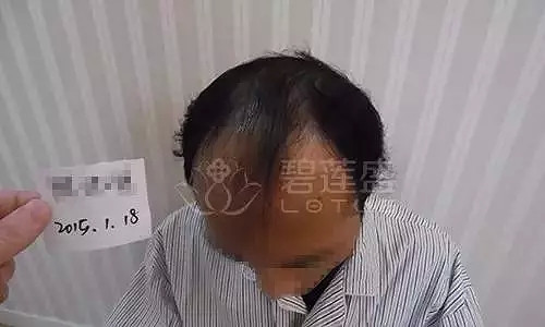 发友故事 | 大面积植发4000毛囊单位,术后升职