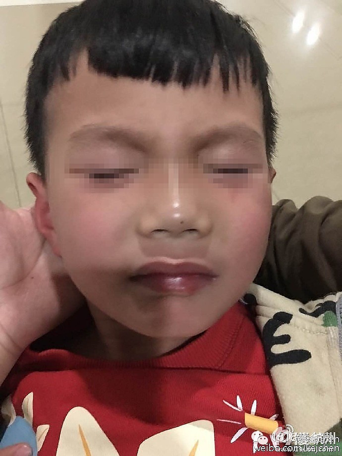 杭州一幼儿园,20多个孩子眼睛红肿刺痛-社会-早