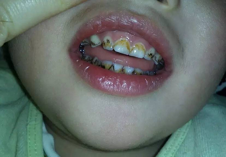 1岁的武汉宝宝萌萌12颗牙齿全部黑掉了,看上去就像40岁的老烟枪,就