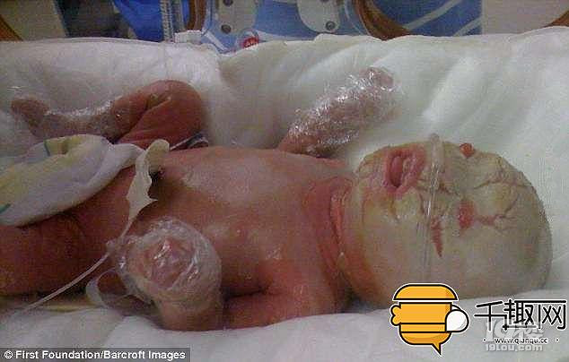 5岁男孩患怪病,皮肤增生极快宛如覆上一层厚鱼