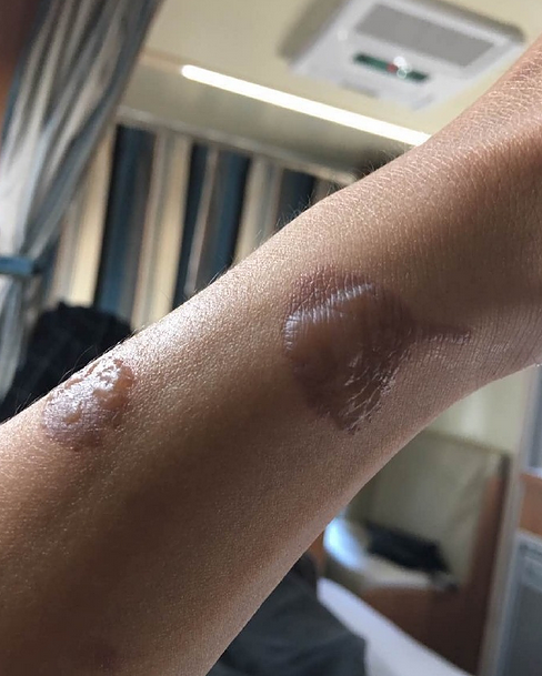 小沈阳被爱妻烫伤留两个疤 安慰沈春阳不要内疚