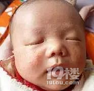 【今日热点】妈妈必看 | 新生儿皮肤问题大汇总