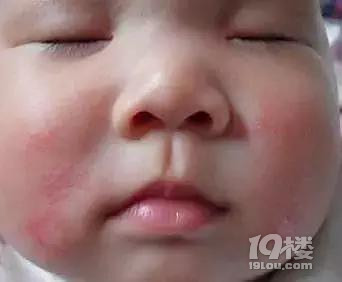 【今日热点】妈妈必看 | 新生儿皮肤问题大汇总