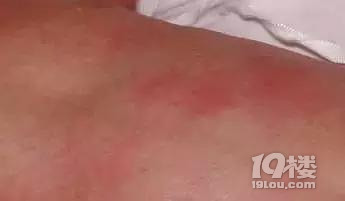 【今日热点】妈妈必看 | 新生儿皮肤问题大汇总
