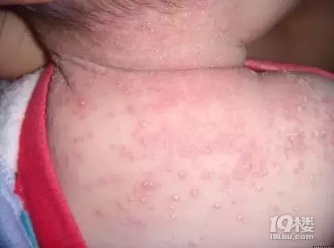 【今日热点】妈妈必看 | 新生儿皮肤问题大汇总
