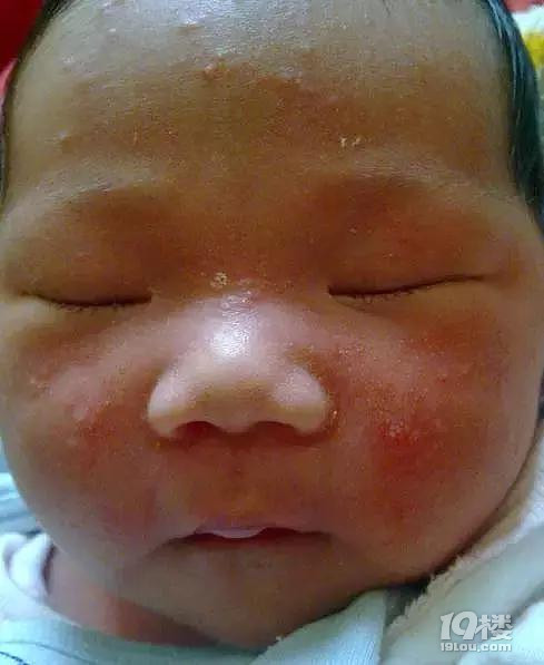 【今日热点】妈妈必看 | 新生儿皮肤问题大汇总