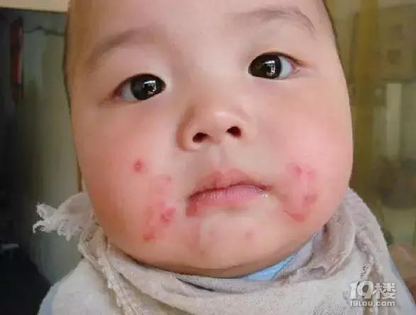 【今日热点】妈妈必看 | 新生儿皮肤问题大汇总