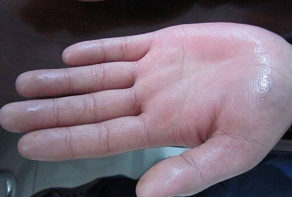 台州17岁女生双手常年滴水,原因竟是得了心病
