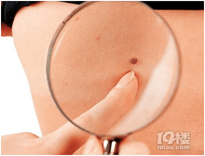 痣多星要当心-健康资讯-健康之家-杭州19楼