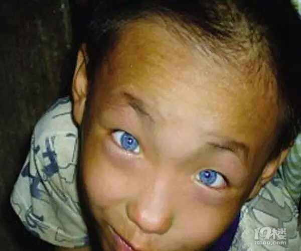 广西一男童长了一双猫眼能夜视
