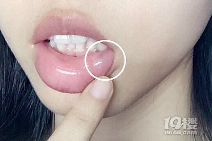 嘴唇唾液腺囊肿一定要手术吗?-网友经验-口腔