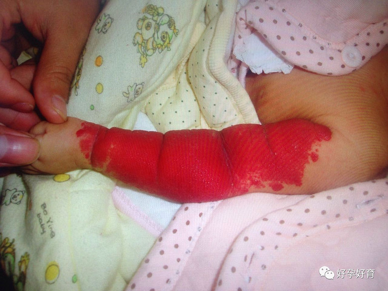 天哪刚出生的宝宝一只手臂竟然是红色的这是什么情况