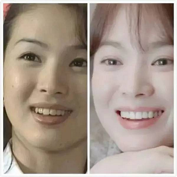 比如演员刘涛,很多人羡慕她白到可以拍牙膏广告的牙齿,但不知道这口