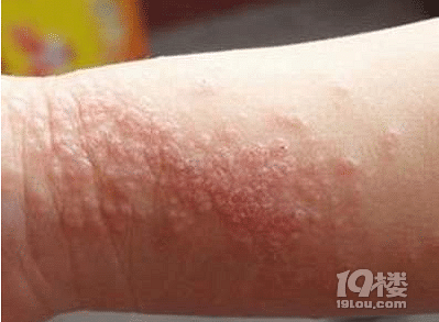 慢性湿疹怎么治疗 如何预防慢性湿疹