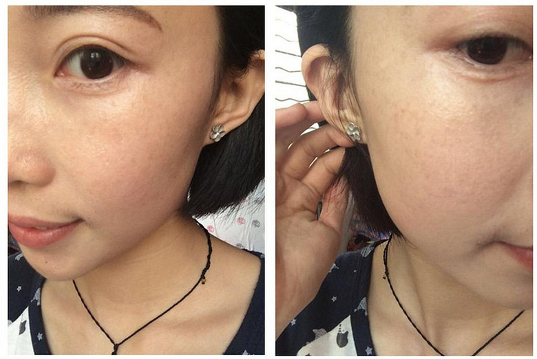 杭州祛斑哪家医院比较好_本人祛斑成功日记