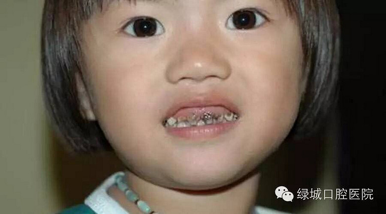 小盆友牙齿变黑是什么原因?_杭州绿城口腔医