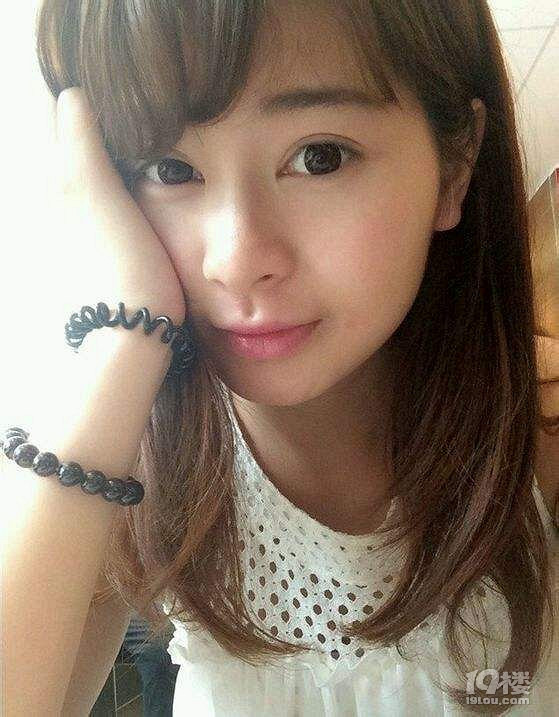 感谢杭州格莱美整形医院张霞飞医生,双眼皮割