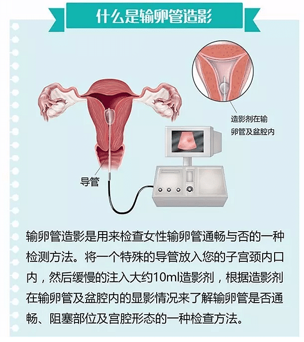 输卵管造影检查步骤图片