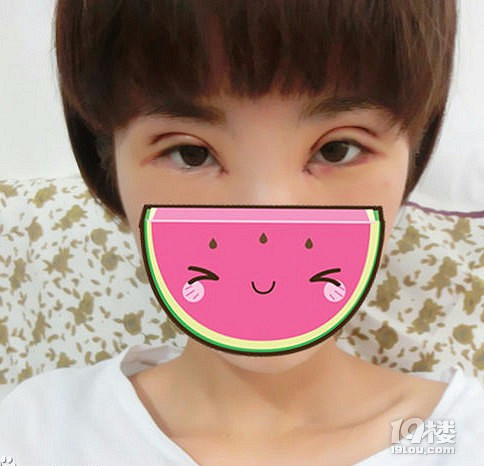 杭州格莱美整形医院做双眼修复如何?-我听说的