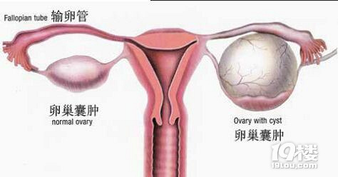 卵巢有囊肿怎么办?卵巢有囊肿怎么回事?