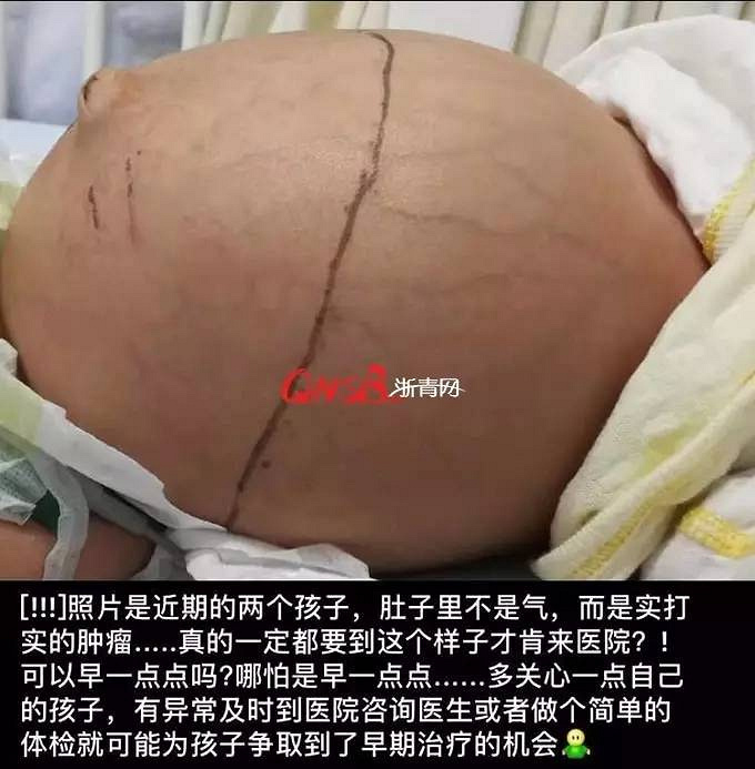 浙江3月大女婴肚子胀到皮球大小!家长给小儿洗